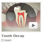 Tooth Decay Crown
